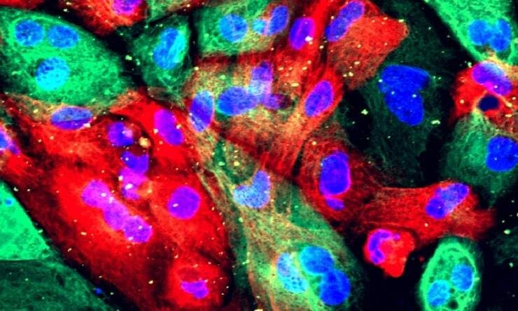 Two prostate cancer mutations reveal opposite responses to ferroptosis therapy