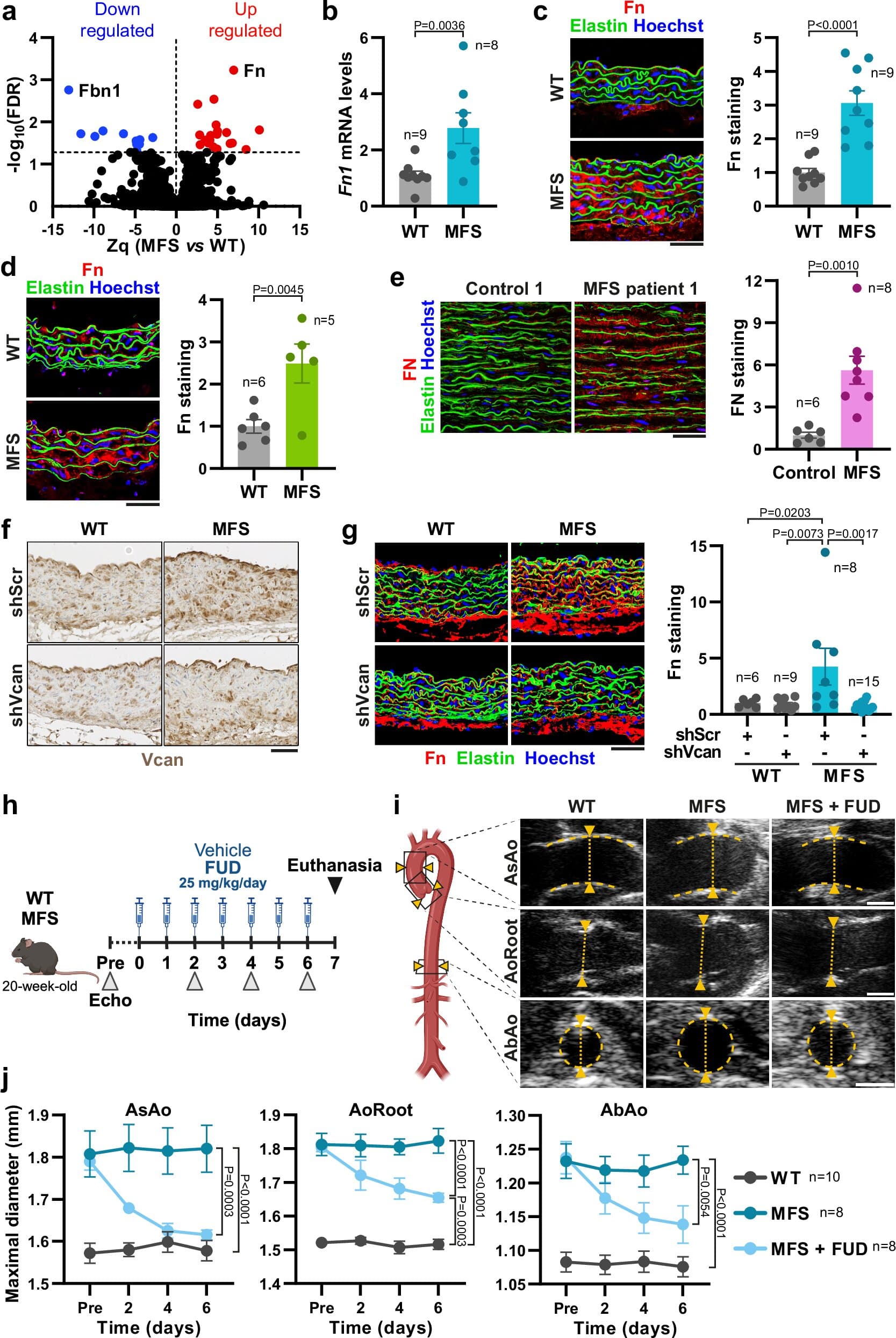 Fibronectin pathway may drive Marfan aortic damage, opening new drug targets