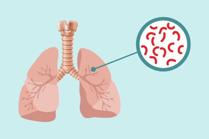 Tuberculosis: Why Haven’t We Eliminated TB Yet?