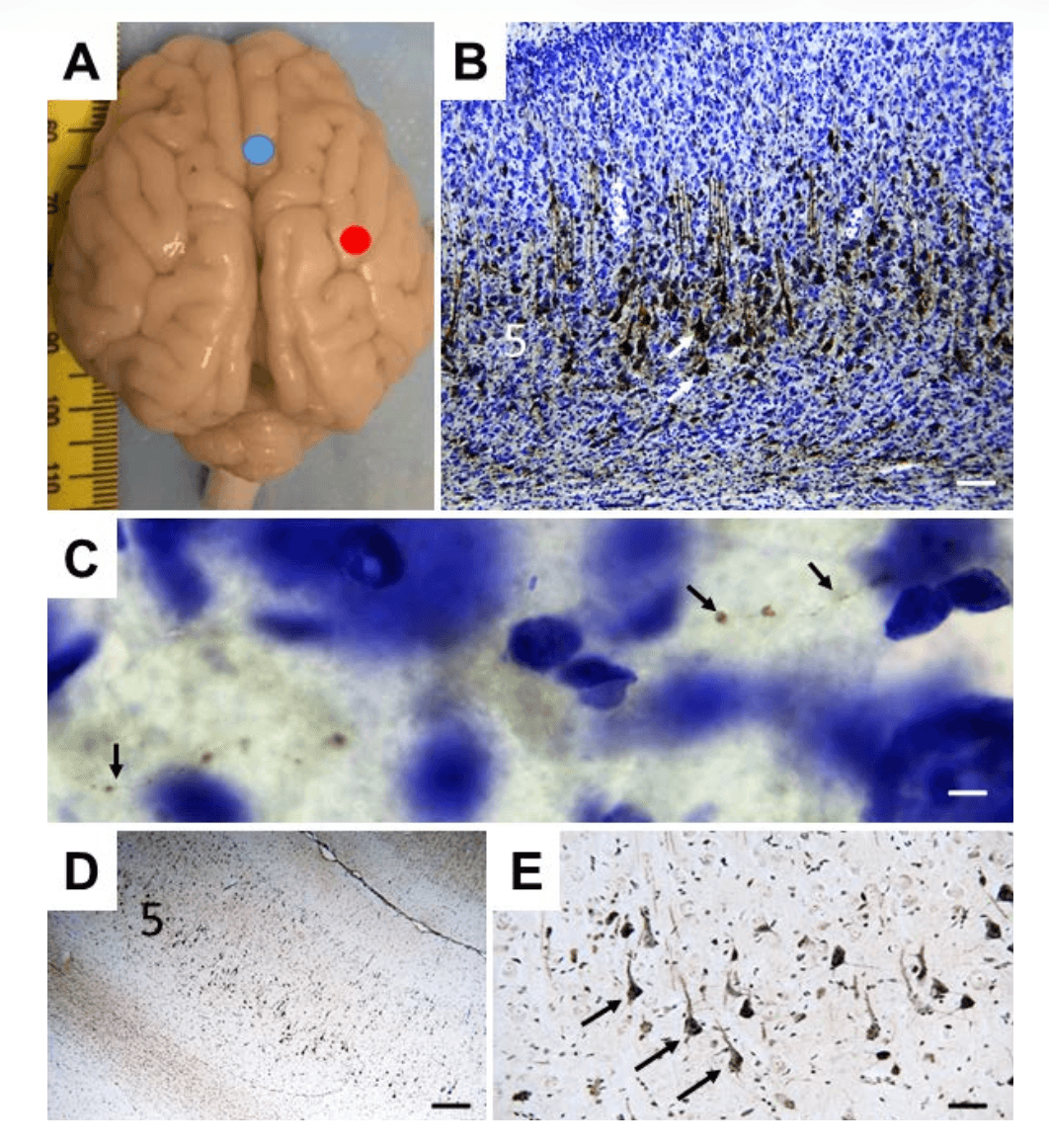 Trojan horses, mitochondrial mischief, and infant brain injury
